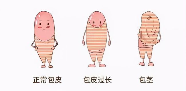 儿童包皮一定要切吗,MK官网